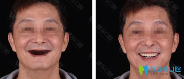 <!--<i data=20240703-sp></i>-->維樂口腔種植牙效果案例 <!--<i data=20240703-sp></i>-->維樂口腔種植牙效果案例