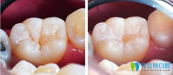 <!--<i data=20240703-sp></i>-->維樂口腔根管治療齲齒補(bǔ)牙后效果 <!--<i data=20240703-sp></i>-->維樂口腔根管治療齲齒補(bǔ)牙后效果