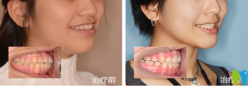 恩吉口腔牙齒矯正前后效果對(duì)比圖 恩吉口腔牙齒矯正前后效果對(duì)比圖