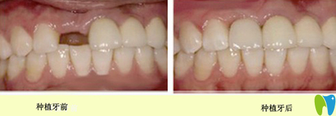 寧波恩吉口腔種植牙前后效果對(duì)比圖 寧波恩吉口腔種植牙前后效果對(duì)比圖