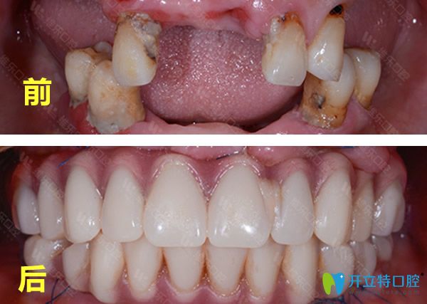 <!--<i data=20240703-sp></i>-->維樂(lè)口腔種牙前后的效果對(duì)比照