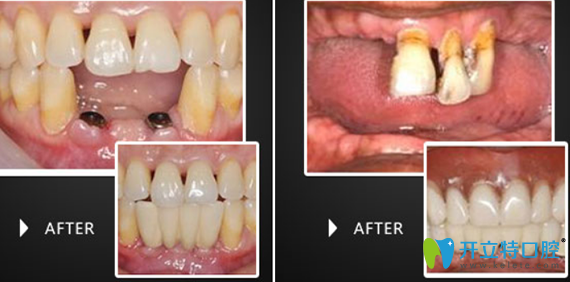 、淮安牙科哪家好點(diǎn)？看牙知道（三淮）口腔牙齒種植案例知