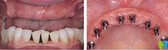 重慶維樂(lè)口腔半口牙缺失種植前