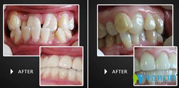 淮安評價(jià)好的口腔是哪家？牙知道口腔牙齒矯正治療效果來驗(yàn)證