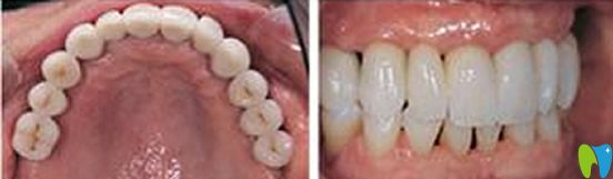 維樂(lè)口腔即刻種植牙術(shù)后效果