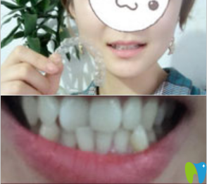 上海永華口腔看牙怎么樣?分享我做隱適美牙齒矯正的實記