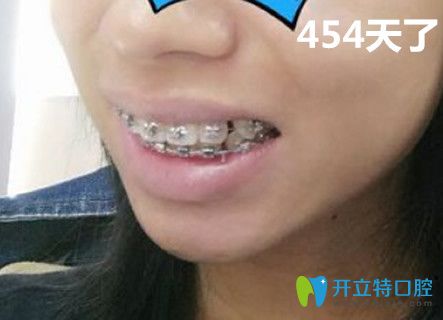 牙知道口腔做牙齒正畸第454天效果圖 牙知道口腔做牙齒正畸第454天效果圖