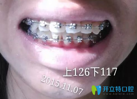 在淮安牙知道口腔戴牙套8個(gè)月左右牙齒變化照 在淮安牙知道口腔戴牙套8個(gè)月左右牙齒變化照