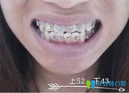 淮安牙知道口腔牙齒正畸后1個(gè)多月照 淮安牙知道口腔牙齒正畸后1個(gè)多月照