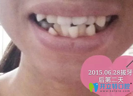 較后一次在淮安牙知道(三淮)拔牙后第二天 較后一次在淮安牙知道(三淮)拔牙后第二天