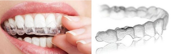 哪些人不適合戴隱形牙套 牙套的種類、價格及優(yōu)劣勢大比拼