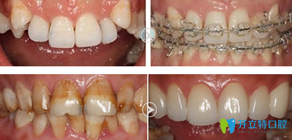 廣州穗華口腔正畸+牙齒美容修復(fù)效果案例