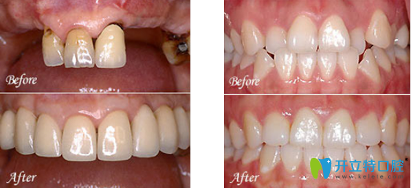 廣州暨博口腔種植牙及牙齒矯正效果案例