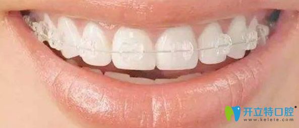 陶瓷自鎖托槽矯正器