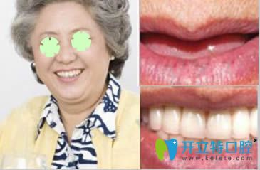 重慶皇仕種植牙效果對比照 重慶皇仕種植牙效果對比照