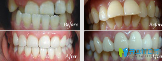 魯璇牙齒矯正真人案例前后效果對(duì)比圖