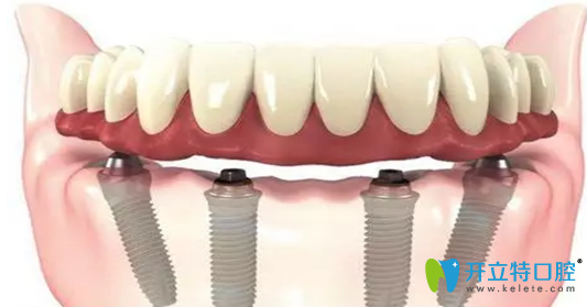 普通植牙技術(shù)講解