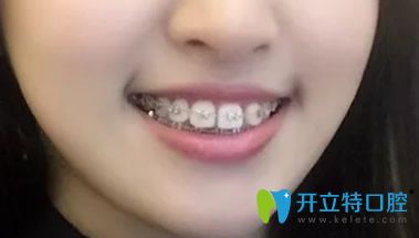 大眾口腔矯正牙齒兩年后效果