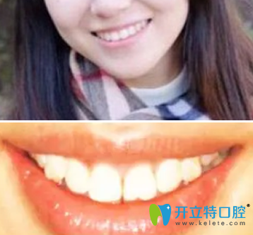 我在西安美奧口腔做隱適美牙齒矯正一年的的效果