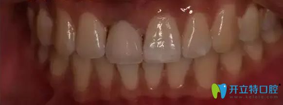 北京永康口腔門牙缺失修復(fù)后效果 北京永康口腔門牙缺失修復(fù)后效果