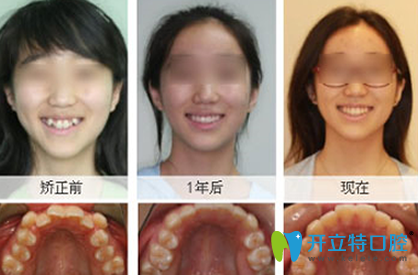 美奧口腔牙齒矯正前后效果對比圖 美奧口腔牙齒矯正前后效果對比圖
