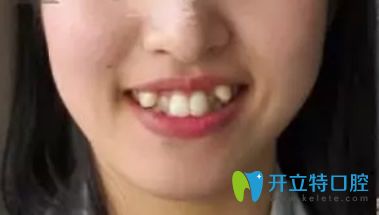 武漢愛(ài)尚大眾口腔牙齒矯正前