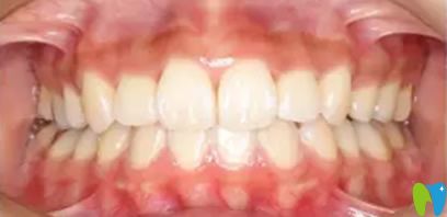 永康口腔吳醫(yī)生牙齒正畸術(shù)后效果