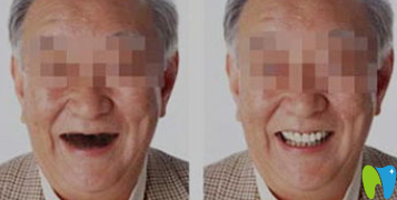 西安美奧口腔屈鐵軍種植牙案例效果圖 西安美奧口腔屈鐵軍種植牙案例效果圖