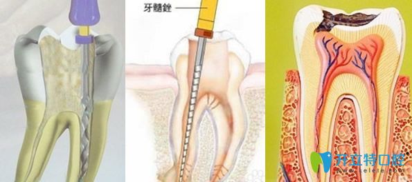 根管治療對(duì)技術(shù)要求很高