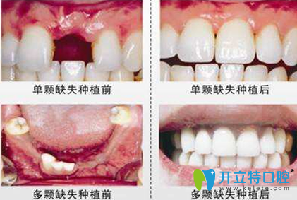 西安美奧口腔種植牙效果對比圖 西安美奧口腔種植牙效果對比圖