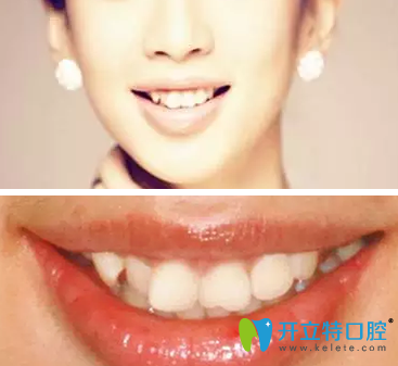 我很幸運在西安美奧口腔做隱適美牙齒矯正還減了1萬元費用