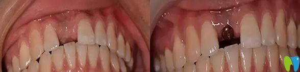 黃院長(zhǎng)牙齒缺失案例種植前 黃院長(zhǎng)牙齒缺失案例種植前