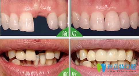 成都瑞泰口腔種植牙效果對比圖
