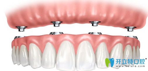 永康口腔黃世宇院長為王大媽設計的診療方案