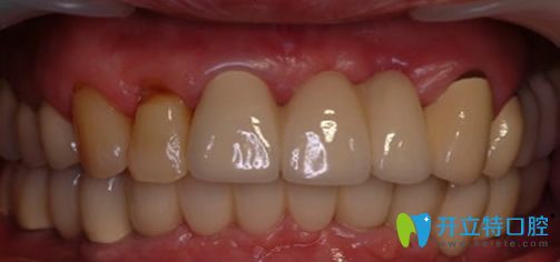 黃院長“即可用”種植術(shù)后效果圖