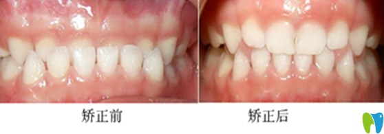 三歲小朋友在杭州拜博口腔做乳牙反頜的矯正案例 三歲小朋友在杭州拜博口腔做乳牙反頜的矯正案例