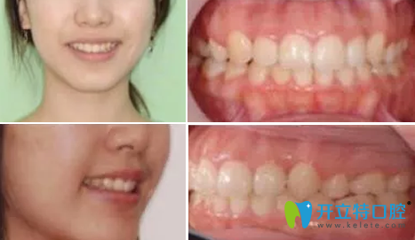 我在成都瑞泰口腔做隱形牙齒矯正一年的效果