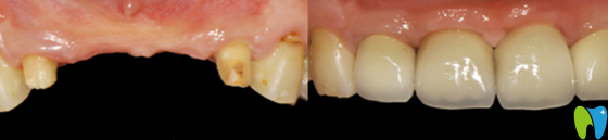 拜博口腔翟建博牙齒種植案例 拜博口腔翟建博牙齒種植案例