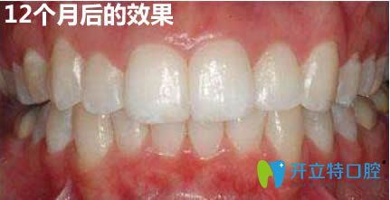 在<!--<i data=20240703-sp></i>-->馬瀧齒科做完隱適美牙齒矯正12個月的效果