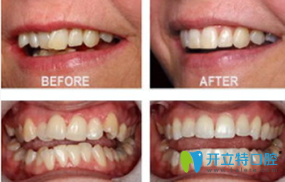 瑞泰口腔牙齒矯正前后效果對比圖