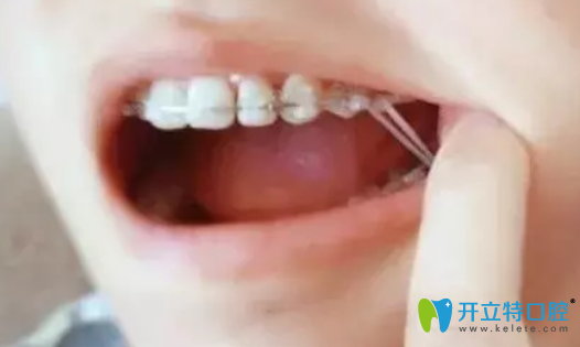 矯正牙齒中的橡皮筋有什么用