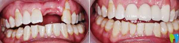 健齒口腔種植牙效果案例