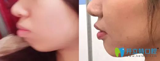 牙齒矯正會(huì)不會(huì)改變臉型