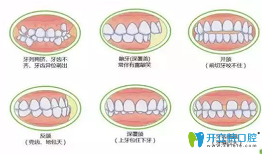 深度揭秘：在做牙齒矯正之前，你不得不了解的17個問題