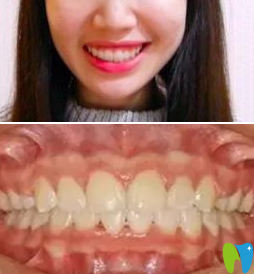 我在鄭州精益口腔做隱形牙齒矯正一年的效果 我在鄭州精益口腔做隱形牙齒矯正一年的效果