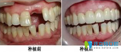 鄭州精益口腔種植牙前后效果對(duì)比圖