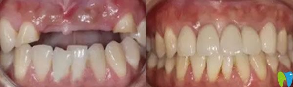 成都瑞爾口腔牙齒種植前后效果圖