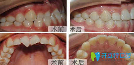 成都亞非牙科黃心建牙齒矯正前后效果對(duì)比圖 成都亞非牙科黃心建牙齒矯正前后效果對(duì)比圖