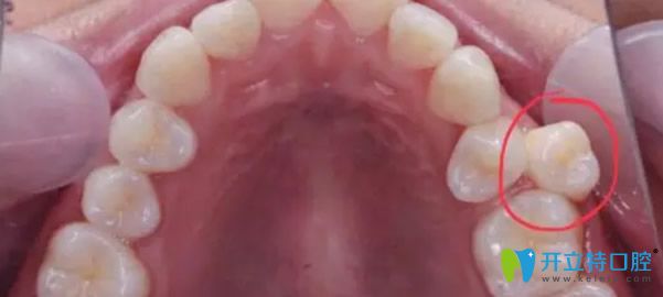 多生牙會(huì)排擠正常的牙齒