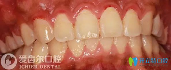 武漢愛齒爾口腔矯正牙齒6個(gè)月效果